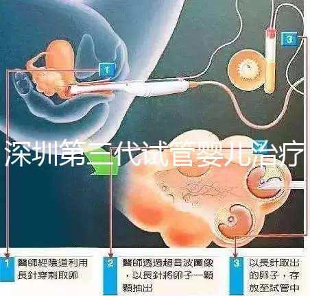 深圳第三代試管嬰兒治療大概需要多少錢？詳細(xì)費(fèi)用清單助您了解預(yù)算