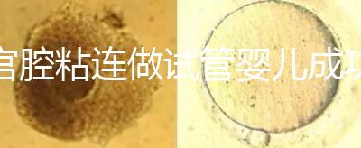 宮腔粘連做試管嬰兒成功率普遍很低?并不會具體要看癥狀